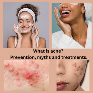 What is Acne? Prevention, Myths and Treatments